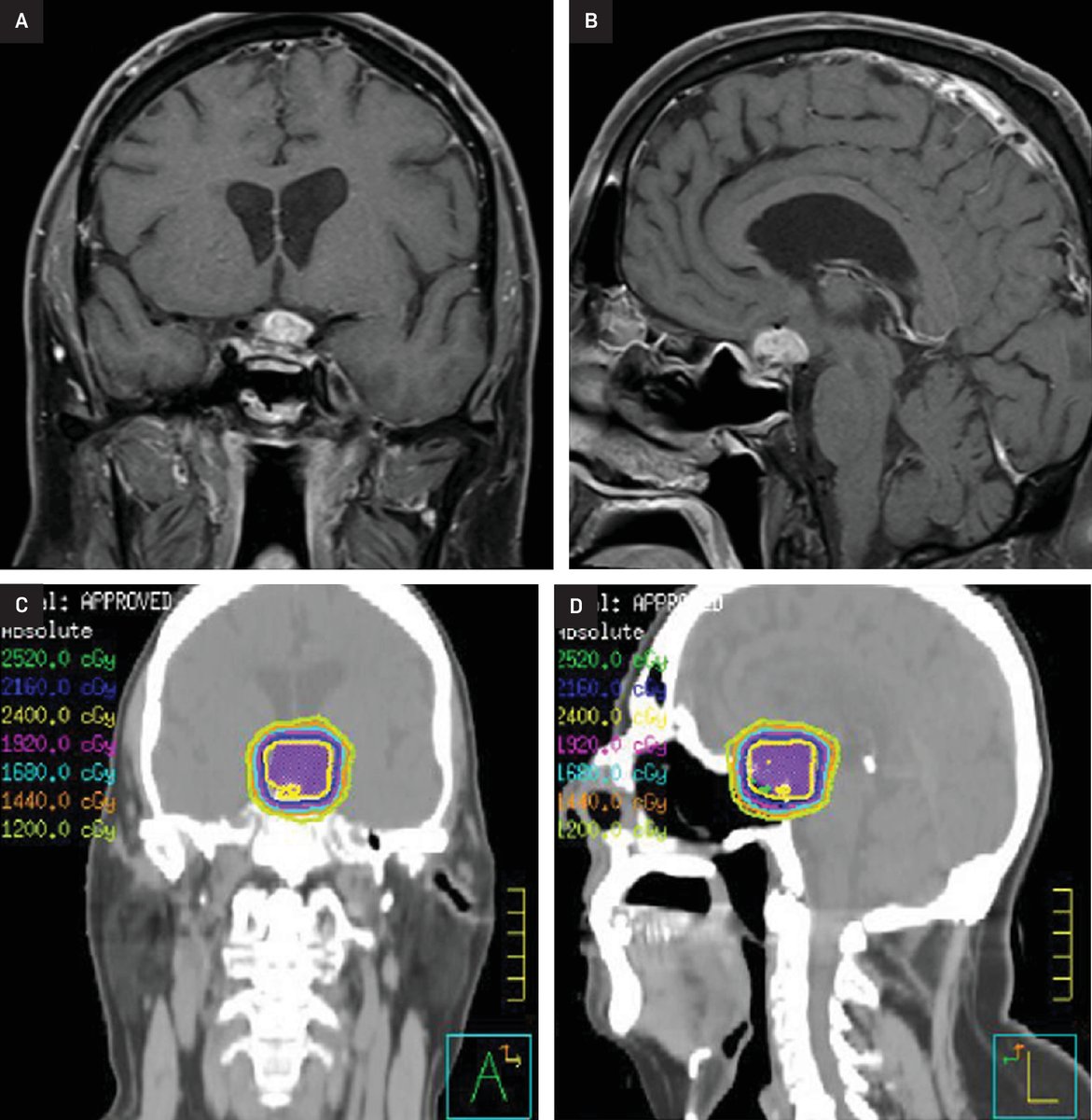 Applied_RadOnc's tweet image. Successful Reirradiation of Multiply Recurrent Lymphocytic Hypophysitis: A Case Report
 
🔗 Learn more: zurl.co/SHIAP 

#RadOnc #RadiationOncology #CancerCare #CaseStudy #RadOncEd #MedEd