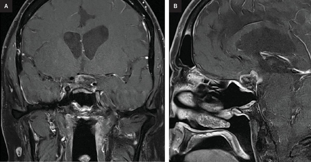 Applied_RadOnc's tweet image. Successful Reirradiation of Multiply Recurrent Lymphocytic Hypophysitis: A Case Report
 
🔗 Learn more: zurl.co/SHIAP 

#RadOnc #RadiationOncology #CancerCare #CaseStudy #RadOncEd #MedEd