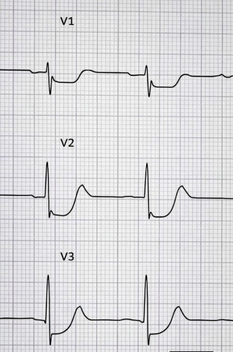 albertoortegana's tweet photo. When you see this pattern on an ECG, what is the first thing that comes to your mind?🤔🤔 ( Patient having suggestive chest pain )

( Educational purpose only )
@docakx @Dr_Chibuike_M @Dr_Shiv_kumar_ @drobiy12 @hemo_shk @shakilED https://t.co/gr6Cb2qM9f