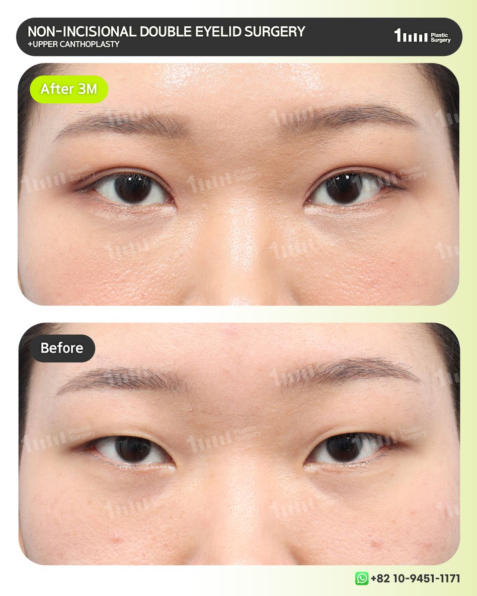1mmEng18987's tweet image. A natural, softly defined crease with a brighter and more defined eye appearance
We focus on enhancing your natural beauty, not changing who you are.

📲 +82 10-9451-1171 (Whatsapp)
👉 KAKAO: 1mmps_Eng
⭐ LINE: 1mmps_Eng
📧 1mmps.eng@gmail.com

#doubleeyelidsurgery #des #1mmPS