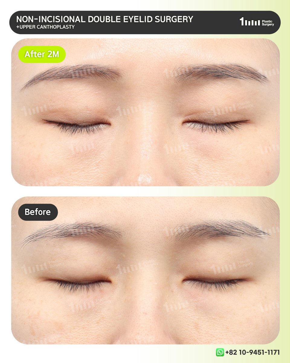 1mmEng18987's tweet image. Gently opened inner corners and a naturally defined crease for a fresher look. 

📲 +82 10-9451-1171 (Whatsapp)
👉 KAKAO: 1mmps_Eng
⭐ LINE: 1mmps_Eng
📧 1mmps.eng@gmail.com

#doubleeyelidsurgery #blepharoplasty #des #uppercanthoplasty #epicanthoplasty #canthoplasty #1mmPS