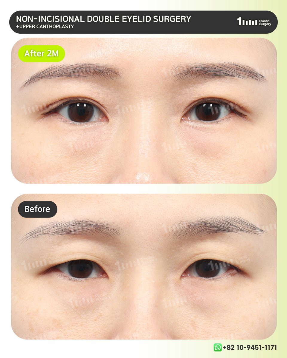 1mmEng18987's tweet image. Gently opened inner corners and a naturally defined crease for a fresher look. 

📲 +82 10-9451-1171 (Whatsapp)
👉 KAKAO: 1mmps_Eng
⭐ LINE: 1mmps_Eng
📧 1mmps.eng@gmail.com

#doubleeyelidsurgery #blepharoplasty #des #uppercanthoplasty #epicanthoplasty #canthoplasty #1mmPS