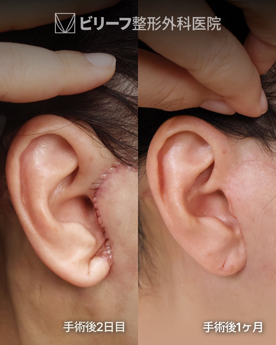 ✨韓国フェイスリフト専門ビリーフ美容外科✨ tweet media