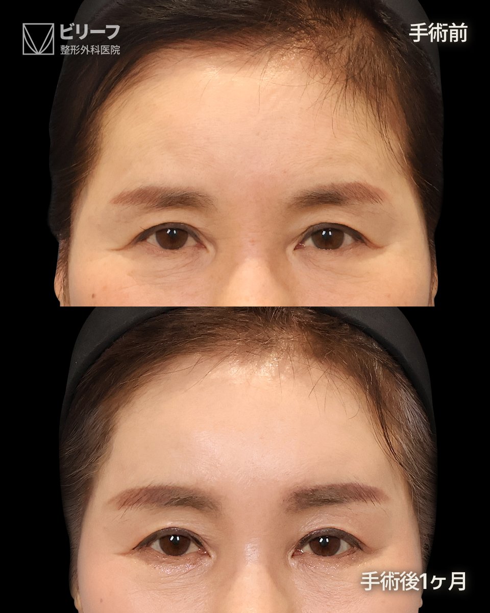 ✨韓国フェイスリフト専門ビリーフ美容外科✨ tweet media