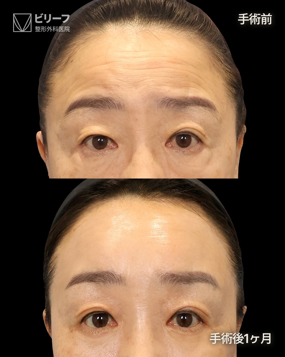 ✨韓国フェイスリフト専門ビリーフ美容外科✨ tweet media