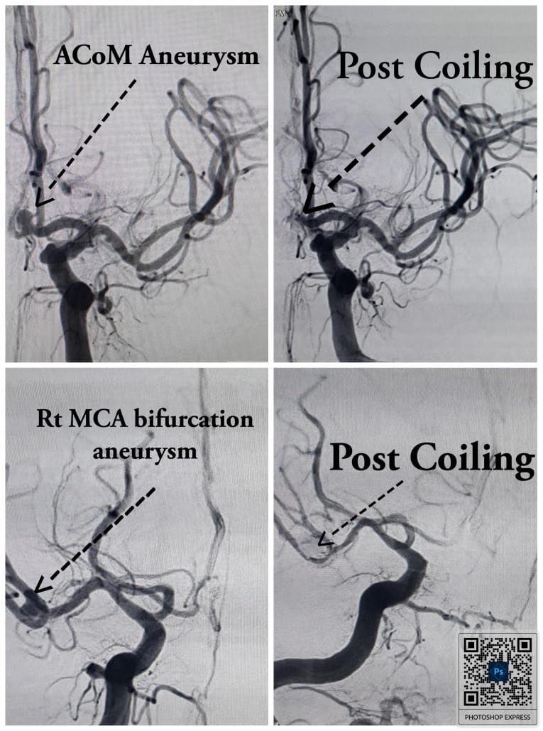 AIIMS_Guwahati's tweet photo. A remarkable story of resilience & medical excellence from AIIMS Guwahati.

A 40-year-old man with a massive subarachnoid hemorrhage due to ruptured intracranial aneurysms was treated with emergency endovascular coiling of ACOM & right MCA bifurcation aneurysms in a single sitting, followed by emergency EVD placement.

Despite complications, he made a full recovery after a month-long battle—a true victory over death.

A testament to cutting-edge care & seamless teamwork by the Departments of Diagnostic & Interventional Radiology, Neurosurgery, and Anaesthesiology, Critical Care & Pain Medicine.

#AIIMS #Healthcare #MedicalExcellence