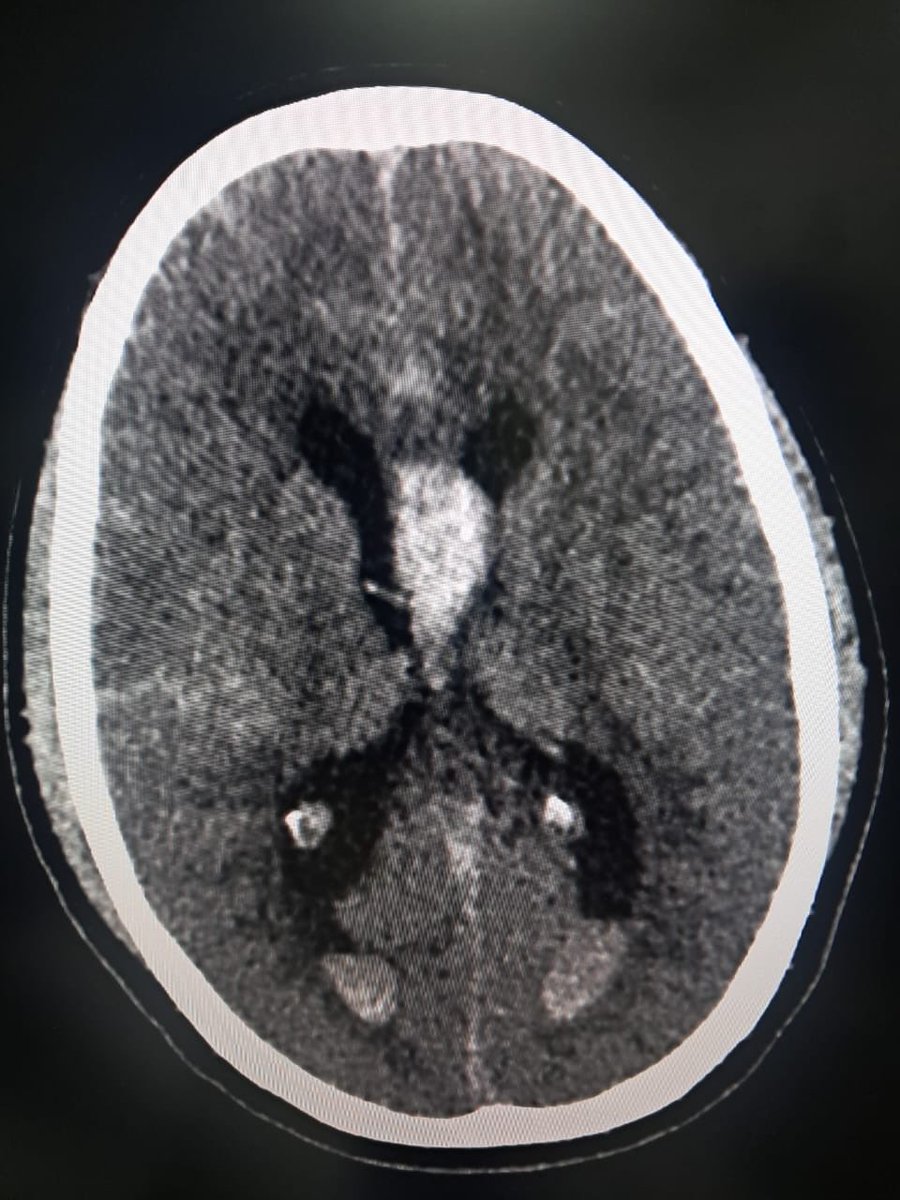 AIIMS_Guwahati's tweet photo. A remarkable story of resilience & medical excellence from AIIMS Guwahati.

A 40-year-old man with a massive subarachnoid hemorrhage due to ruptured intracranial aneurysms was treated with emergency endovascular coiling of ACOM & right MCA bifurcation aneurysms in a single sitting, followed by emergency EVD placement.

Despite complications, he made a full recovery after a month-long battle—a true victory over death.

A testament to cutting-edge care & seamless teamwork by the Departments of Diagnostic & Interventional Radiology, Neurosurgery, and Anaesthesiology, Critical Care & Pain Medicine.

#AIIMS #Healthcare #MedicalExcellence