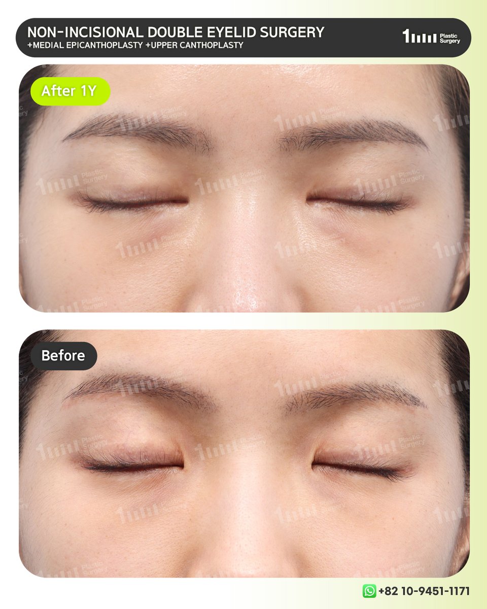 1mmEng18987's tweet image. A refined balance, beyond simple symmetry.

📲 +82 10-9451-1171 (Whatsapp)
👉 KAKAO: 1mmps_Eng
⭐ LINE: 1mmps_Eng
📧 1mmps.eng@gmail.com

#doubleeyelidsurgery #blepharoplasty #des #uppercanthoplasty #epicanthoplasty #canthoplasty #nonincisional #fatgrafting #fatinjection #1mmPS
