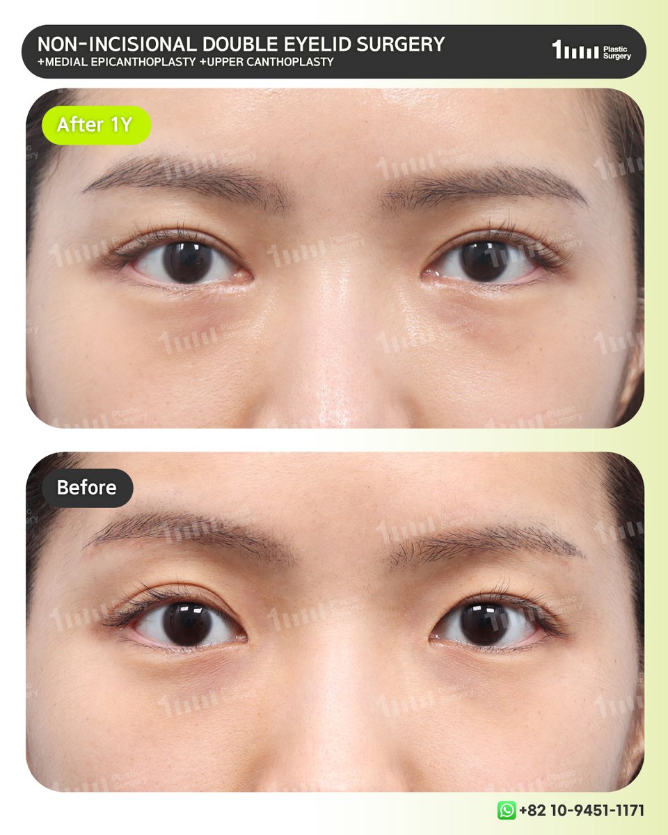 1mmEng18987's tweet image. A refined balance, beyond simple symmetry.

📲 +82 10-9451-1171 (Whatsapp)
👉 KAKAO: 1mmps_Eng
⭐ LINE: 1mmps_Eng
📧 1mmps.eng@gmail.com

#doubleeyelidsurgery #blepharoplasty #des #uppercanthoplasty #epicanthoplasty #canthoplasty #nonincisional #fatgrafting #fatinjection #1mmPS