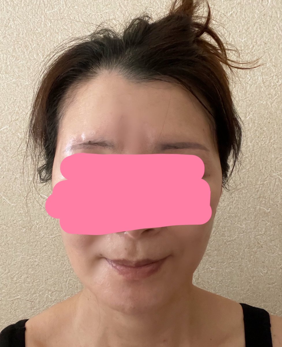 kiko 切開リフトDT中 tweet media