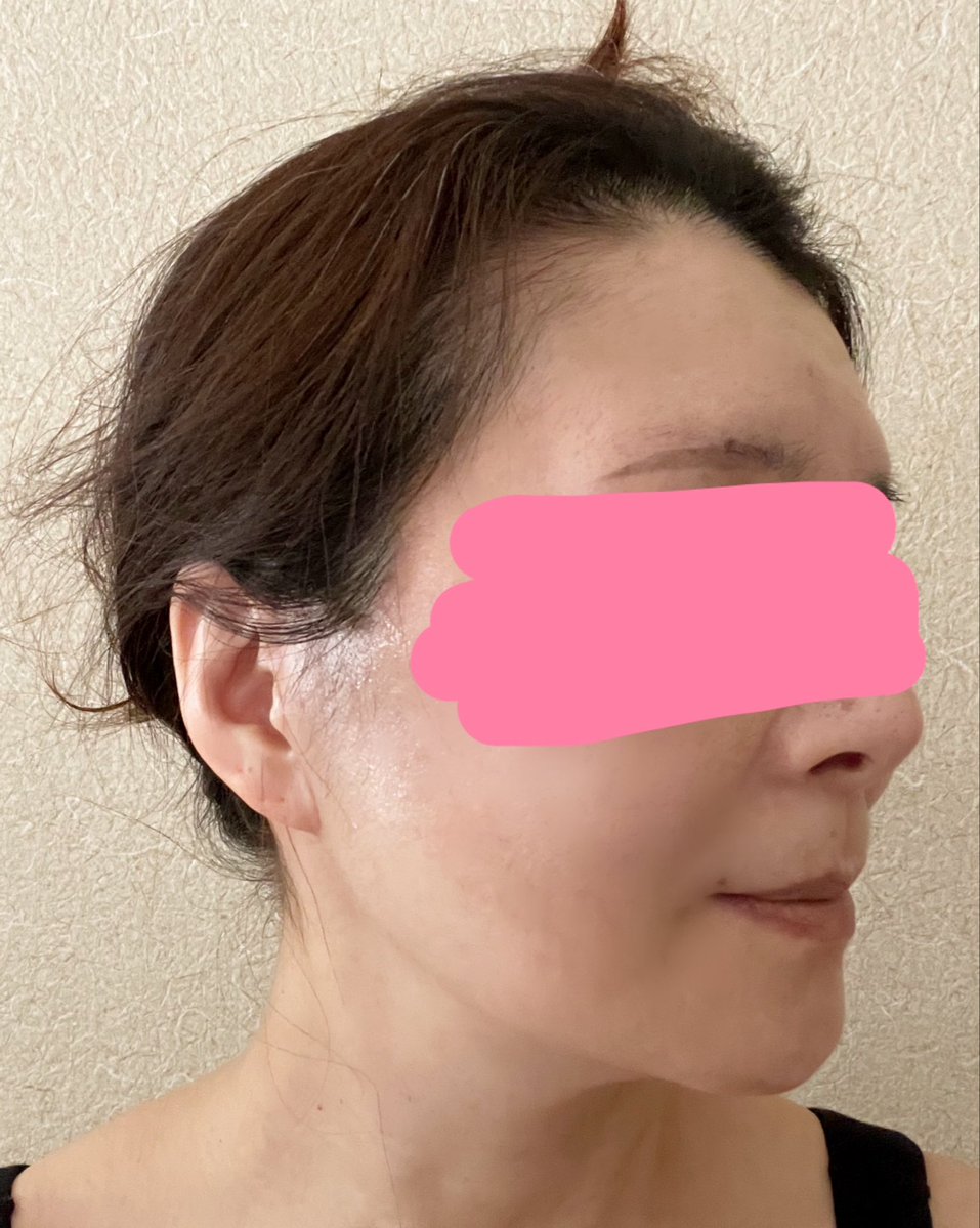 kiko 切開リフトDT中 tweet media