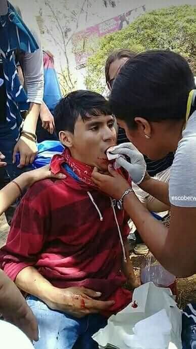 ABRIL 2018, YA ALVARO CONRADO NO PODÍA RESPIRAR POR LA BALA EN SU GARGANTA PROVENIENTE DEL FRANCOTIRADOR SANDINISTA.
Qué momento más espantoso para Alvaro Conrado debe haber sido con esa bala metida en su garganta producto de un francotirador sandinista; solamente tenía 15 años.