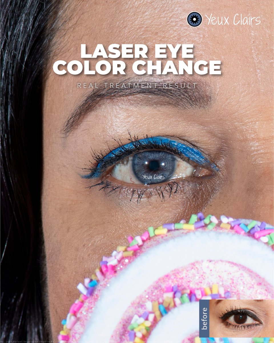 Eye candy. 🍭✨

More results: yeuxclairs.com/gallery
#LaserEyeColorChange #PermanentResults #SafeAndPainless