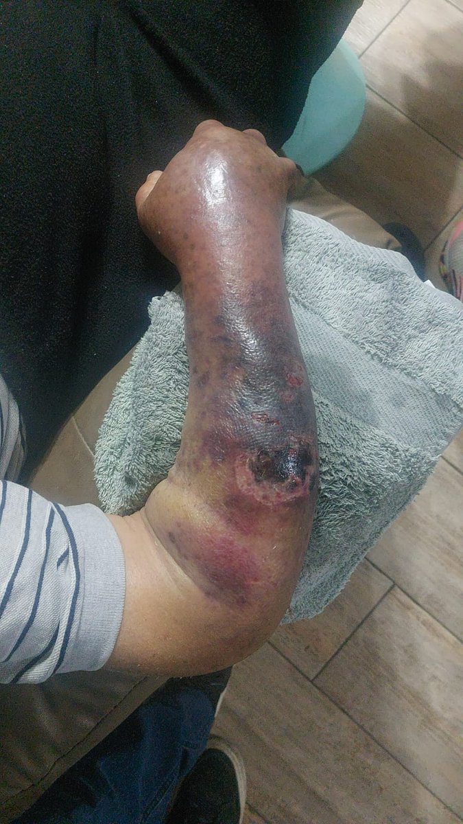 paolasaavedrav's tweet photo. @EsSaludPeru Que bonito post!, ojalá los cirujanos actúen como lo que escriben, tengo a mi abuelo de 97 años desde anoche en rebagliati y nos tienen pelotéandode una lado a otro , tiene el brazo necrosado y nadie lo cura, trauma, cirugía plástica, cirugía, que clase de seres son? no entiendo https://t.co/1va90b7AxV