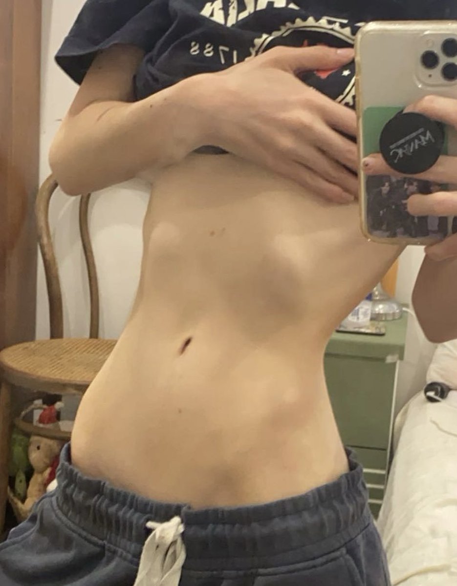 Sh0rtGrainRice's tweet photo. @60sbabydol depends on how you carry weight, muscle mass and you’re literal skeleton shape but probably around 30-35kg. i’m the same height and this was me at 38-40kg https://t.co/pXGCvc8qZ7