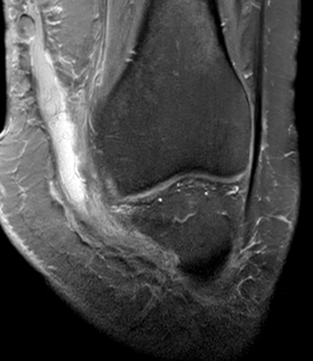 mskteachingroom's tweet photo. Morel-Lavallée lesion https://t.co/dIgpVd7u5b