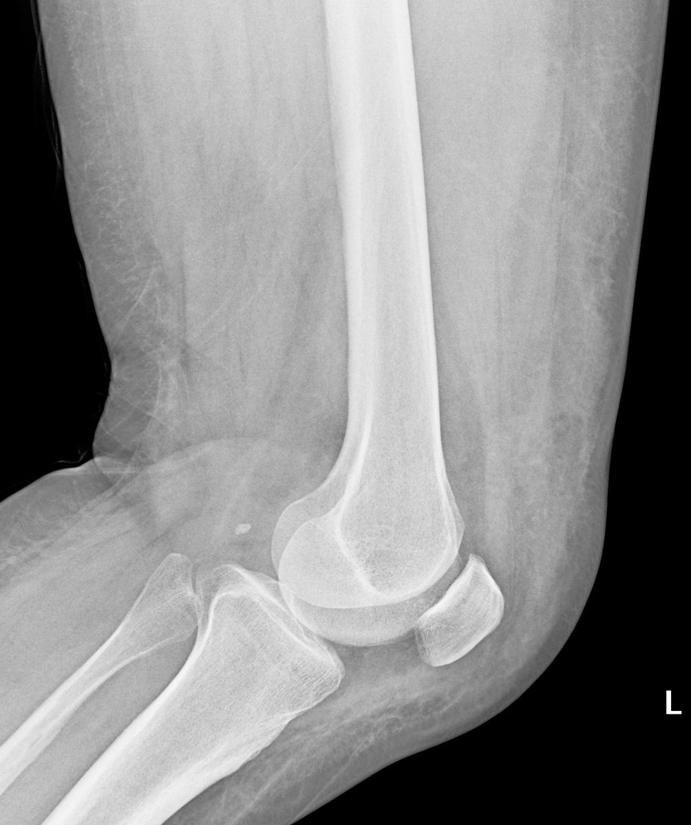 mskteachingroom's tweet photo. Morel-Lavallée lesion https://t.co/dIgpVd7u5b