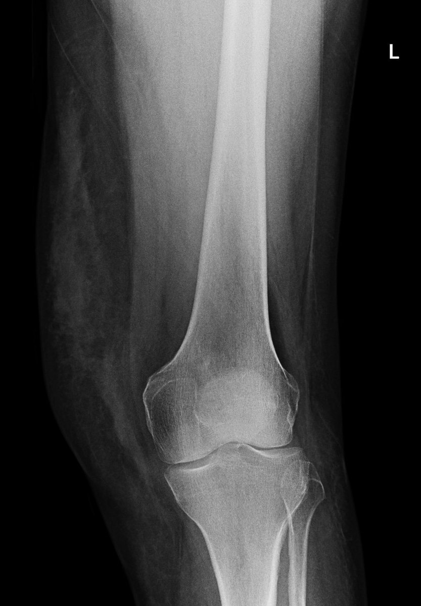 mskteachingroom's tweet photo. Morel-Lavallée lesion https://t.co/dIgpVd7u5b
