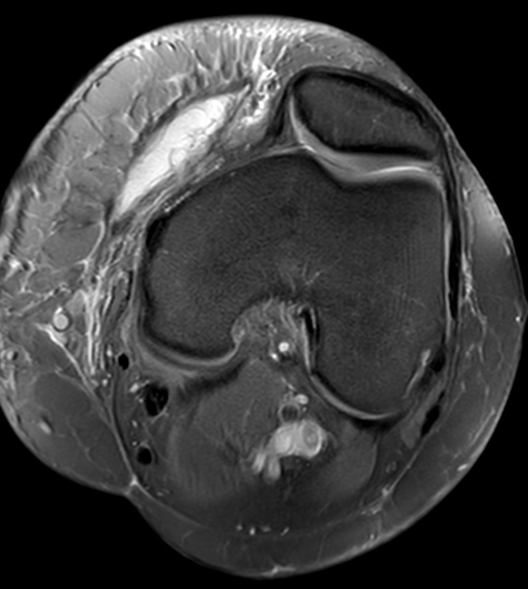 mskteachingroom's tweet photo. Morel-Lavallée lesion https://t.co/dIgpVd7u5b