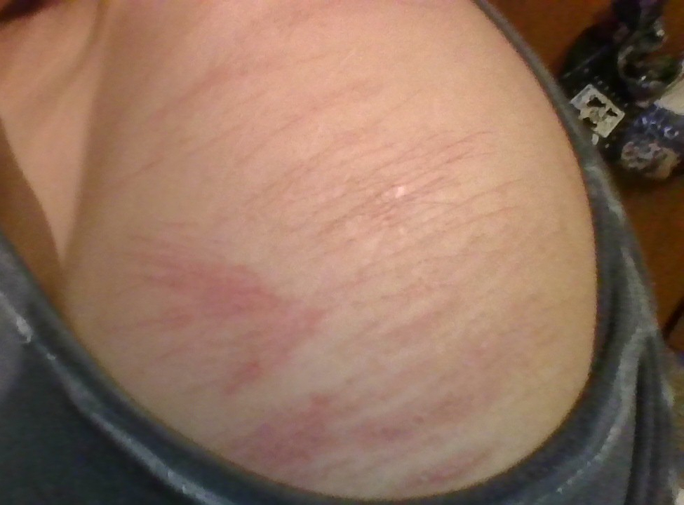 Kentrelltoaster's tweet photo. @kwttipawz tac- for referance this is what the  scars look like https://t.co/O7bSpQuvmA