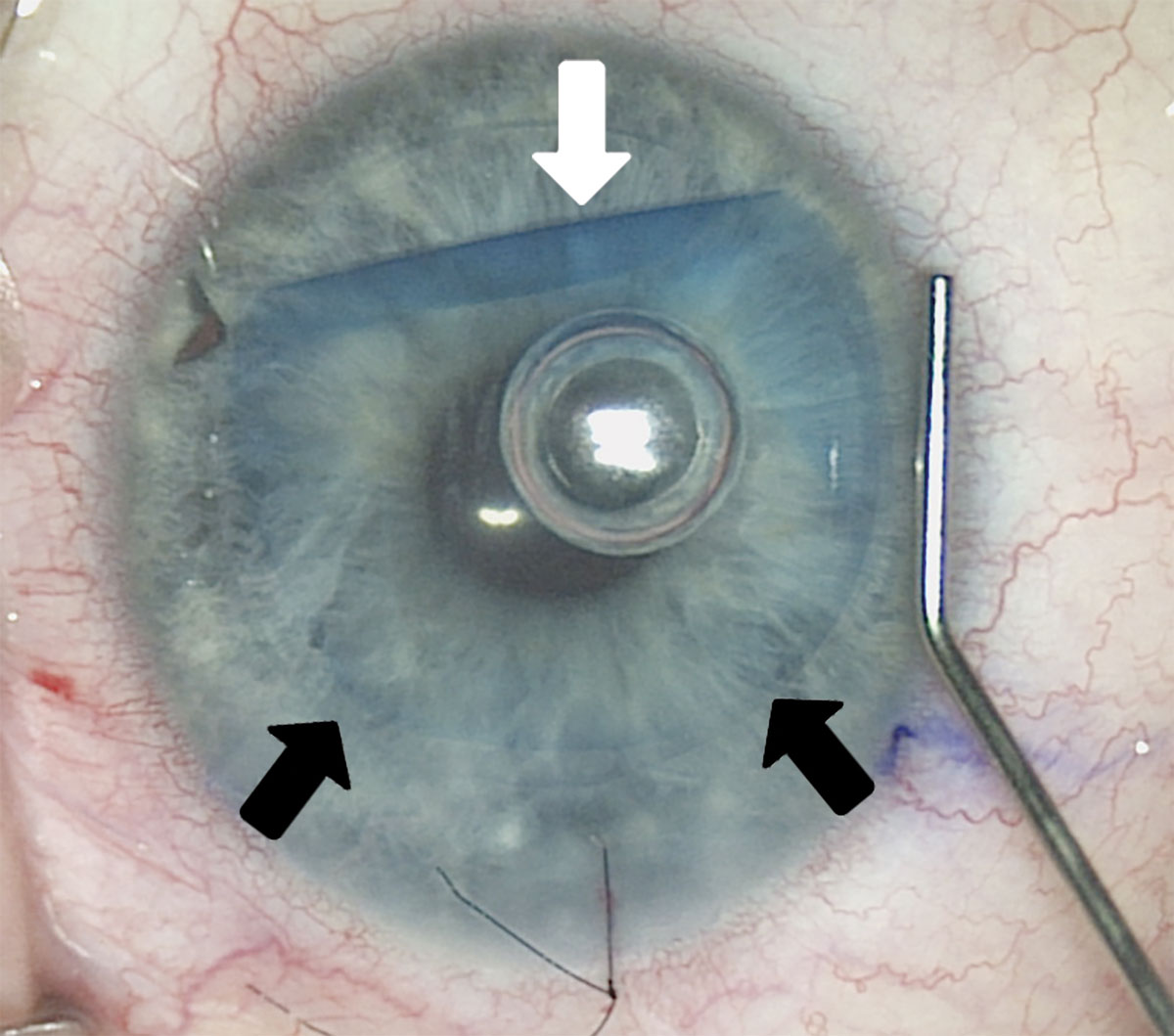 revoptom's tweet image. Corneal Donor Tissue Quality Has Increased

Adverse events are steadily declining, along with cases of infectious keratitis and primary graft failure.
reviewofoptometry.com/article/cornea…

#optometry #cornea #cornealtransplant