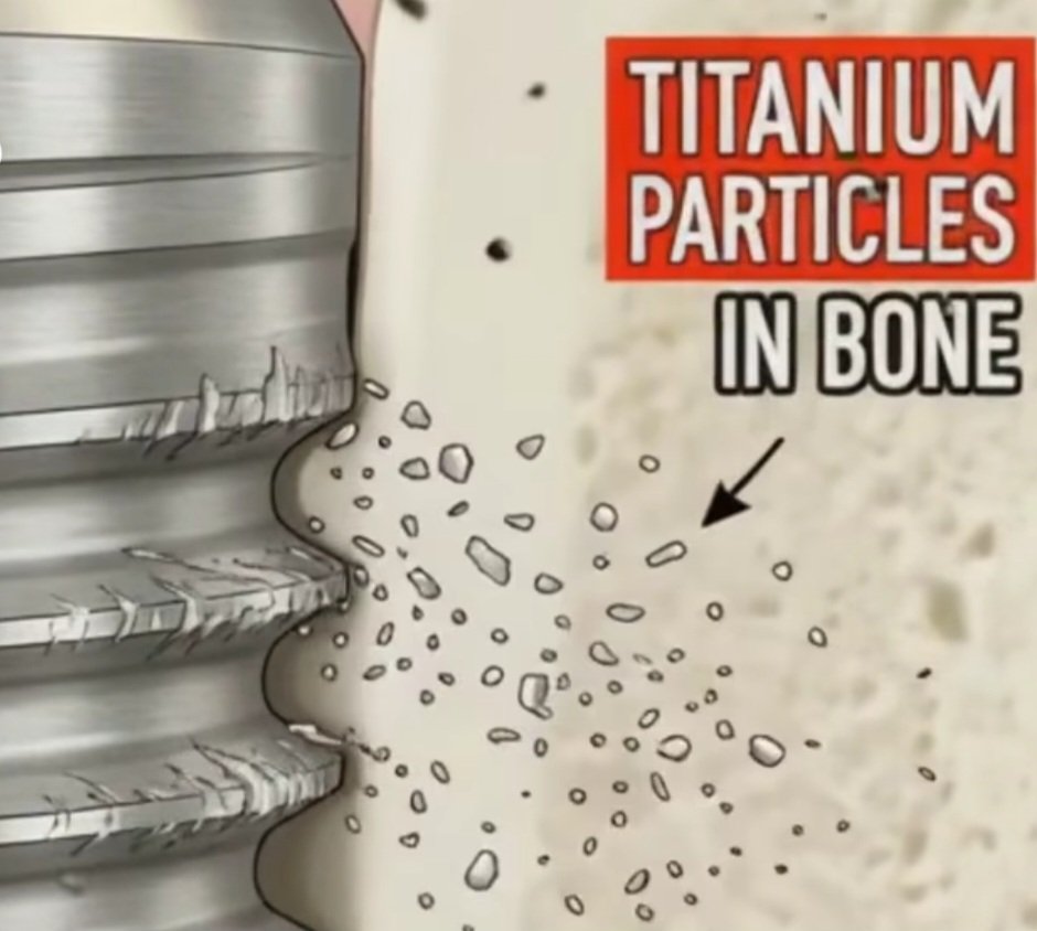 عند إدخال الغرسة مكان الحفر يجب مراعاة عدم أستخدام عزم أكثر من ٥٠ نيوتن في العظم القشري الكثيف لإن ذلك يؤثر على التروية الدموية وينزع جزيئات المعدن من جسم الغرسة وبالتالي يستثير الجهاز المناعي في المنطقة.