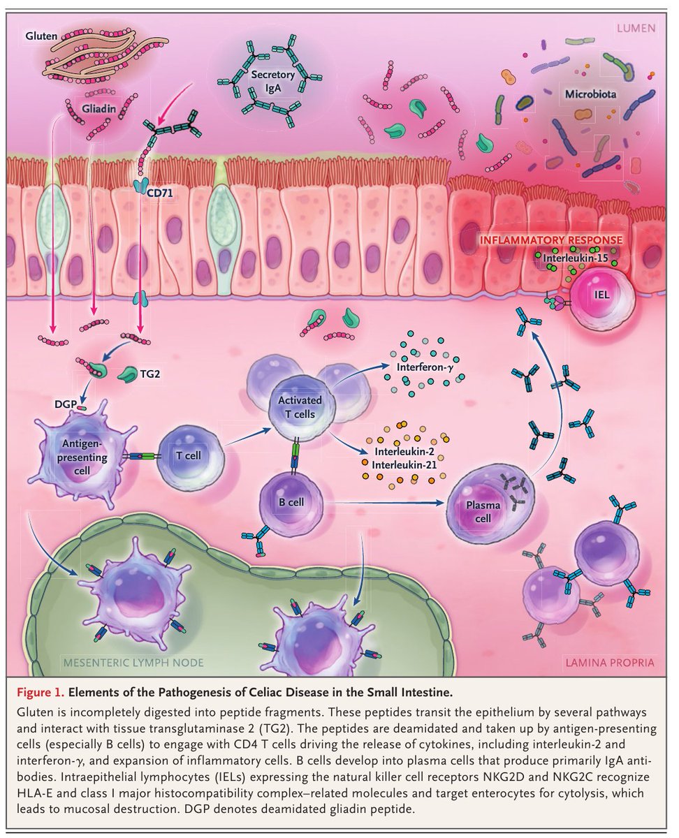 MHcsba's tweet image. New England Journal of Medicine (NEJM) 2026: Enfermedad celiaca
DOI: 10.1056/NEJMcp2415548
#MedEd #MedTwitter #MedX
medicina-interna.org