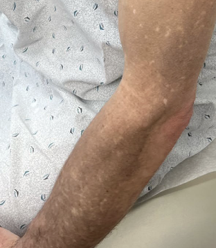 ChristineJKoMD's tweet image. Also yay to Dr. Matthew Friedland! @yalederm resident! onlinelibrary.wiley.com/share/author/F… his article on #kratom #pigmentation #dermpath #dermatology #pathology