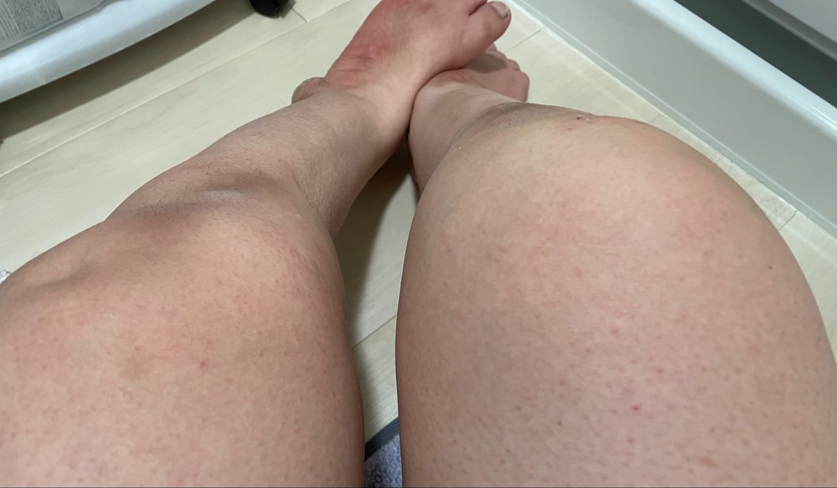 昨日、車椅子から転倒して
前転し、背中に車椅子が被さり
膝をアスファルトにおもいきり
打ち付けたのですが

右膝、ここまで腫れ上がりました。

熱感もあり、ブヨブヨしているので
少し溜まっていた水が膨れて
さらに水が溜まっているように感じる。

ここまでになっても