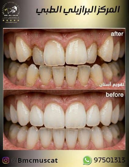 المركز البرازيلي الطبي ( أسنان) مسقط 🇴🇲 tweet media