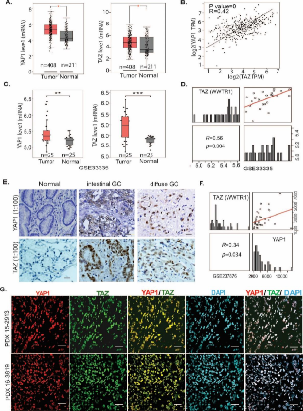 CHP_journal's tweet photo. YAP1 and TAZ are tightly linked in GC:
📈 Both are:
       - Overexpressed in tumors vs normal
       - Positively correlated across cohorts
       - Co-localized in PDX models
🧩 Suggests coordinated oncogenic function https://t.co/yI7E1Jj80f