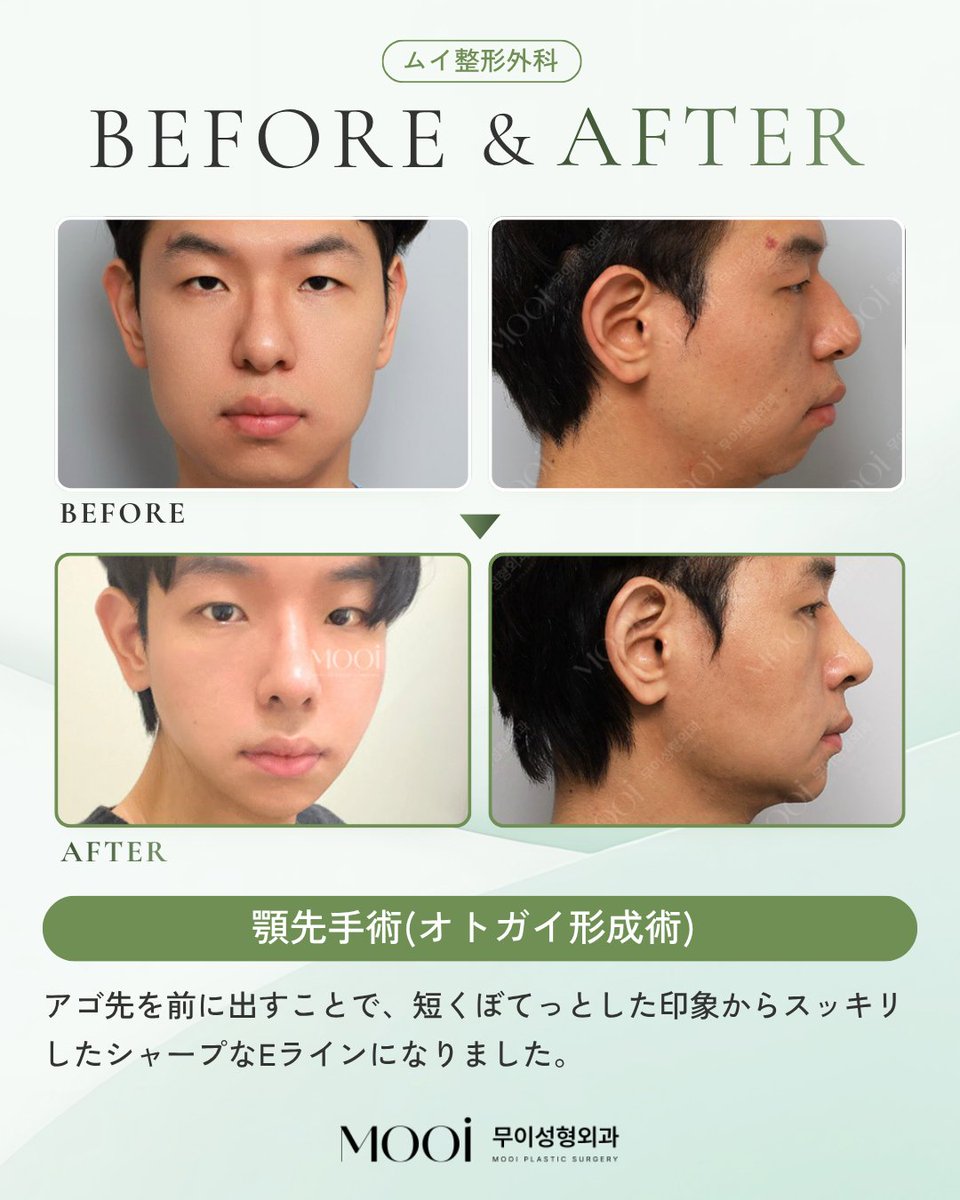 MOOi (ムイ) 整形外科 tweet media