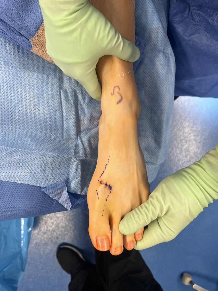 seleneparekhmd's tweet image. Lacerated EHL tendon in a pro athlete = no push-off, no speed.
Primary repair + synthetic novel graft
→ load-sharing support
→ avoids over-stiff repair
→ allows real healing under stress
Back in 10 weeks.
That’s performance-driven surgery.
#SportsMed #ReturnToPlay #PrincetonNJ