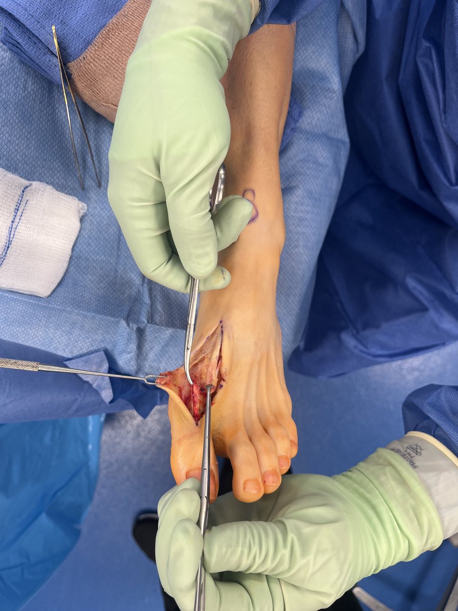 seleneparekhmd's tweet image. Lacerated EHL tendon in a pro athlete = no push-off, no speed.
Primary repair + synthetic novel graft
→ load-sharing support
→ avoids over-stiff repair
→ allows real healing under stress
Back in 10 weeks.
That’s performance-driven surgery.
#SportsMed #ReturnToPlay #PrincetonNJ