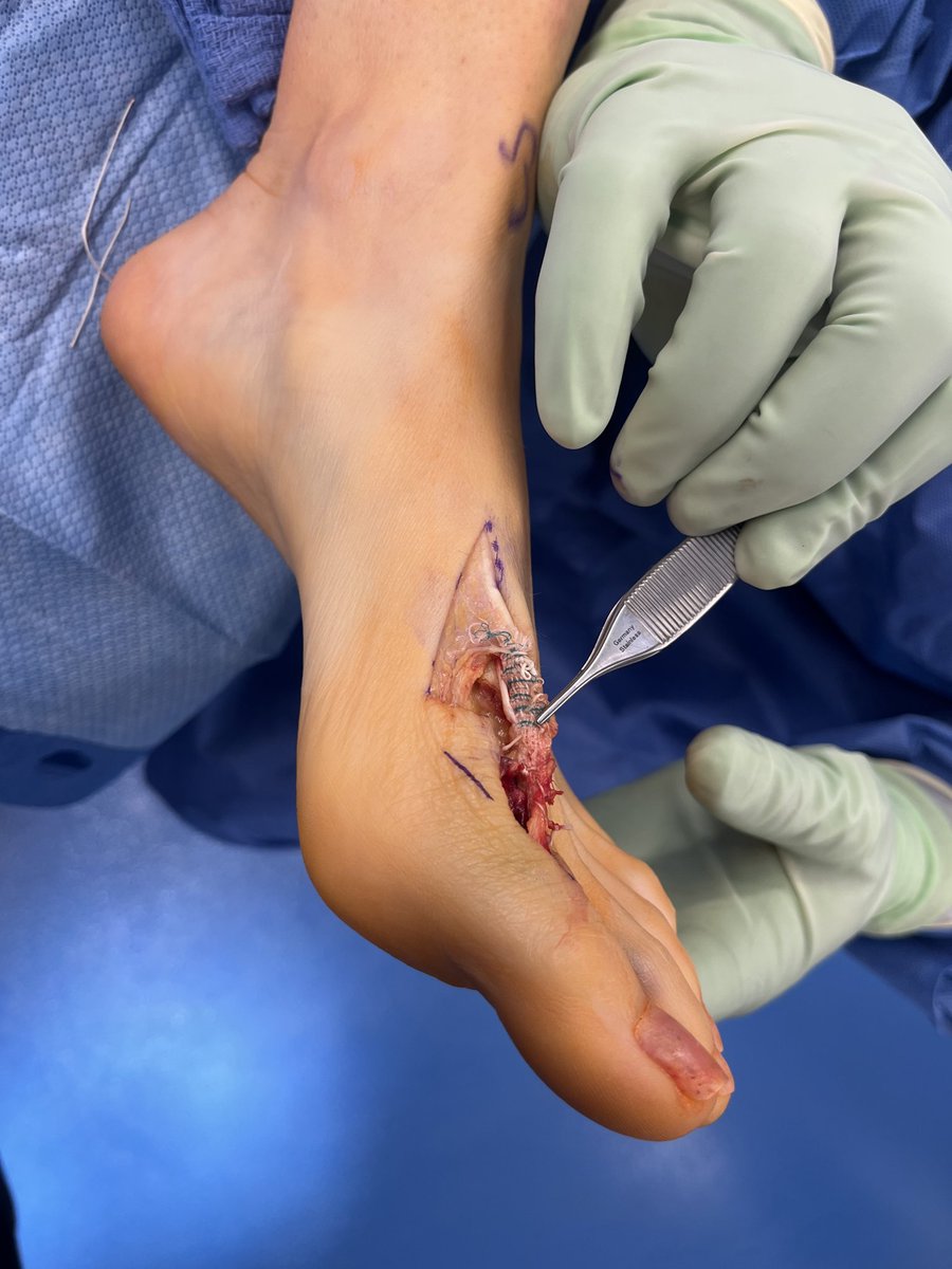 seleneparekhmd's tweet image. Lacerated EHL tendon in a pro athlete = no push-off, no speed.
Primary repair + synthetic novel graft
→ load-sharing support
→ avoids over-stiff repair
→ allows real healing under stress
Back in 10 weeks.
That’s performance-driven surgery.
#SportsMed #ReturnToPlay #PrincetonNJ