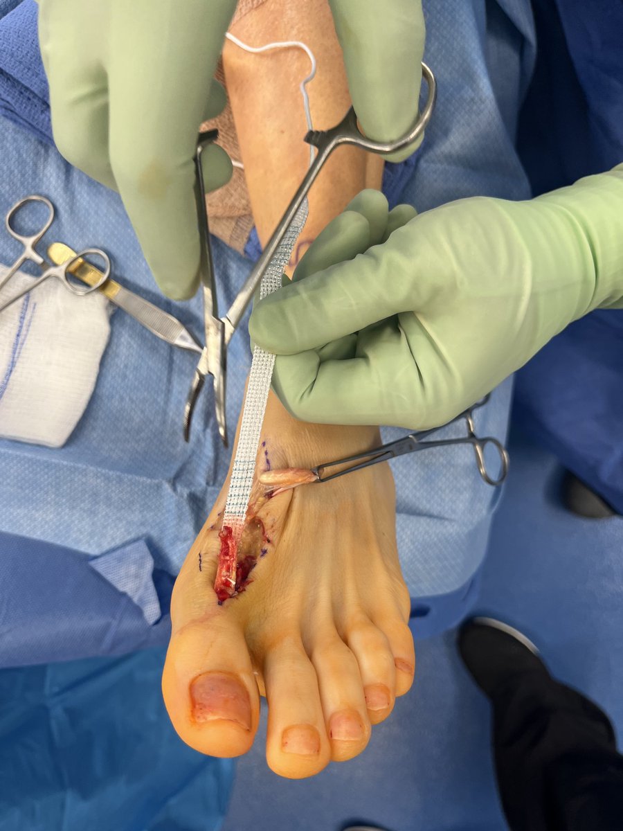 seleneparekhmd's tweet image. Lacerated EHL tendon in a pro athlete = no push-off, no speed.
Primary repair + synthetic novel graft
→ load-sharing support
→ avoids over-stiff repair
→ allows real healing under stress
Back in 10 weeks.
That’s performance-driven surgery.
#SportsMed #ReturnToPlay #PrincetonNJ