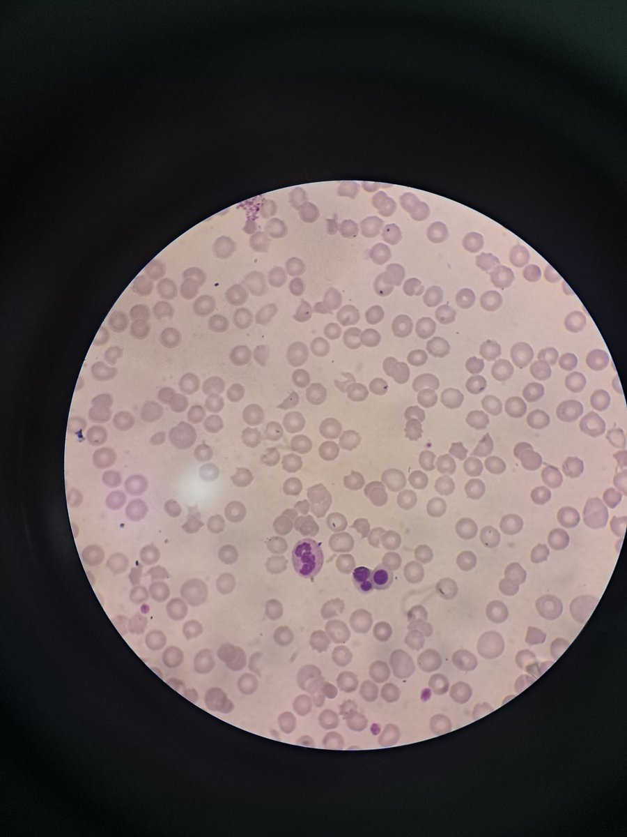 RaihanRaiq's tweet image. Microangiopathic haemolytic anaemia? #hemepath #hematology