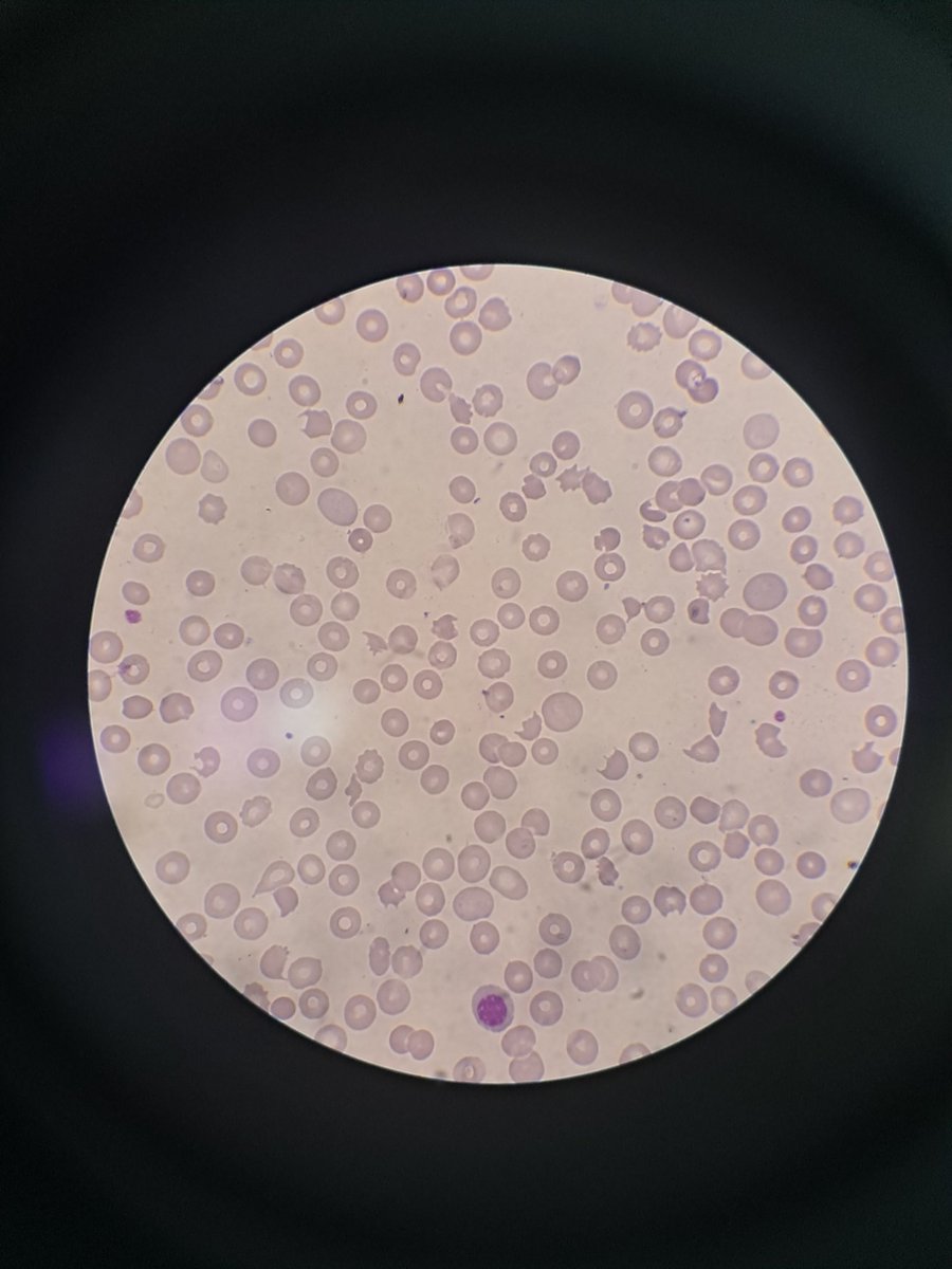 RaihanRaiq's tweet image. Microangiopathic haemolytic anaemia? #hemepath #hematology