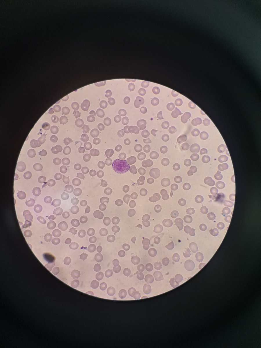 RaihanRaiq's tweet image. Microangiopathic haemolytic anaemia? #hemepath #hematology