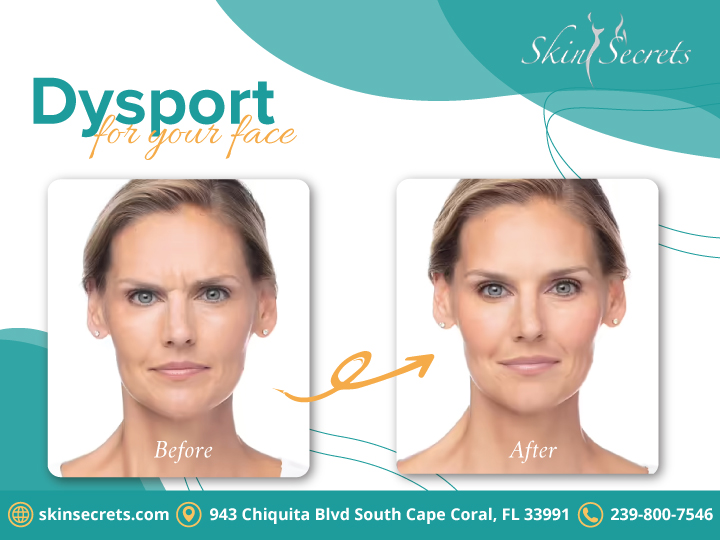 skinsecrets6's tweet photo. Dysport® is a fast-acting, long-lasting injectable that smooths moderate-to-severe lines between the eyebrows—while keeping your natural facial expressions looking like you.

https://t.co/DZjctmGnC4 https://t.co/WkfM0R5bo8