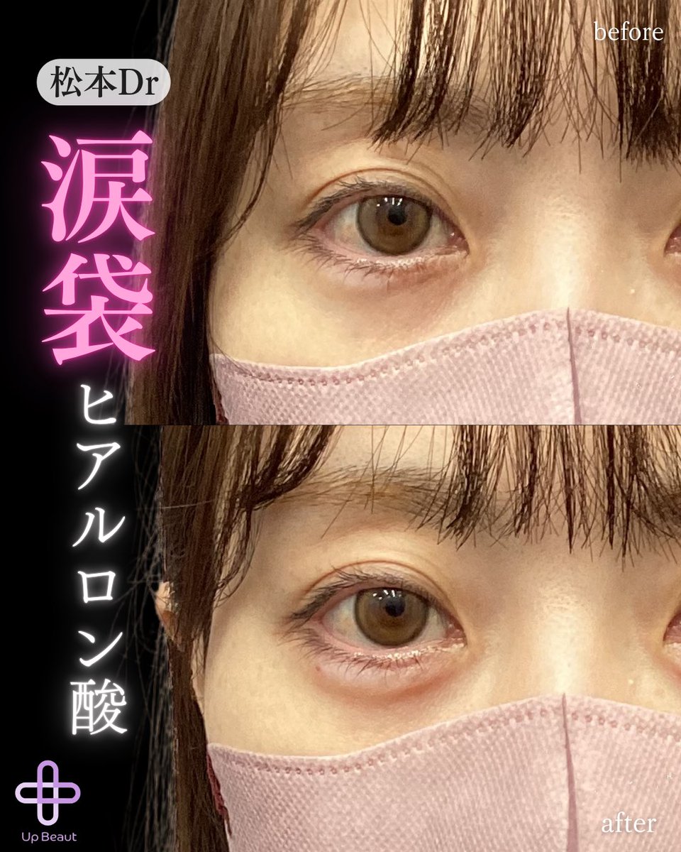 涙袋ヒアルロン酸👁️🎀 担当医👩‍⚕️：松本dr (水曜日勤務) 施術内容