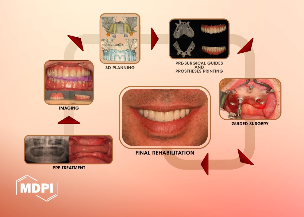 Computer-Guided Flapless Immediate Function Dental Implants for Full-Arch Rehabilitations Using the All-on-4 Concept: A 12-Year Clinical and 10-Year Radiographic Retrospective Study

by de Araújo Nobre et al.

🔓 #Open_Access, free to read at: brnw.ch/21x1qNb

#dentistry