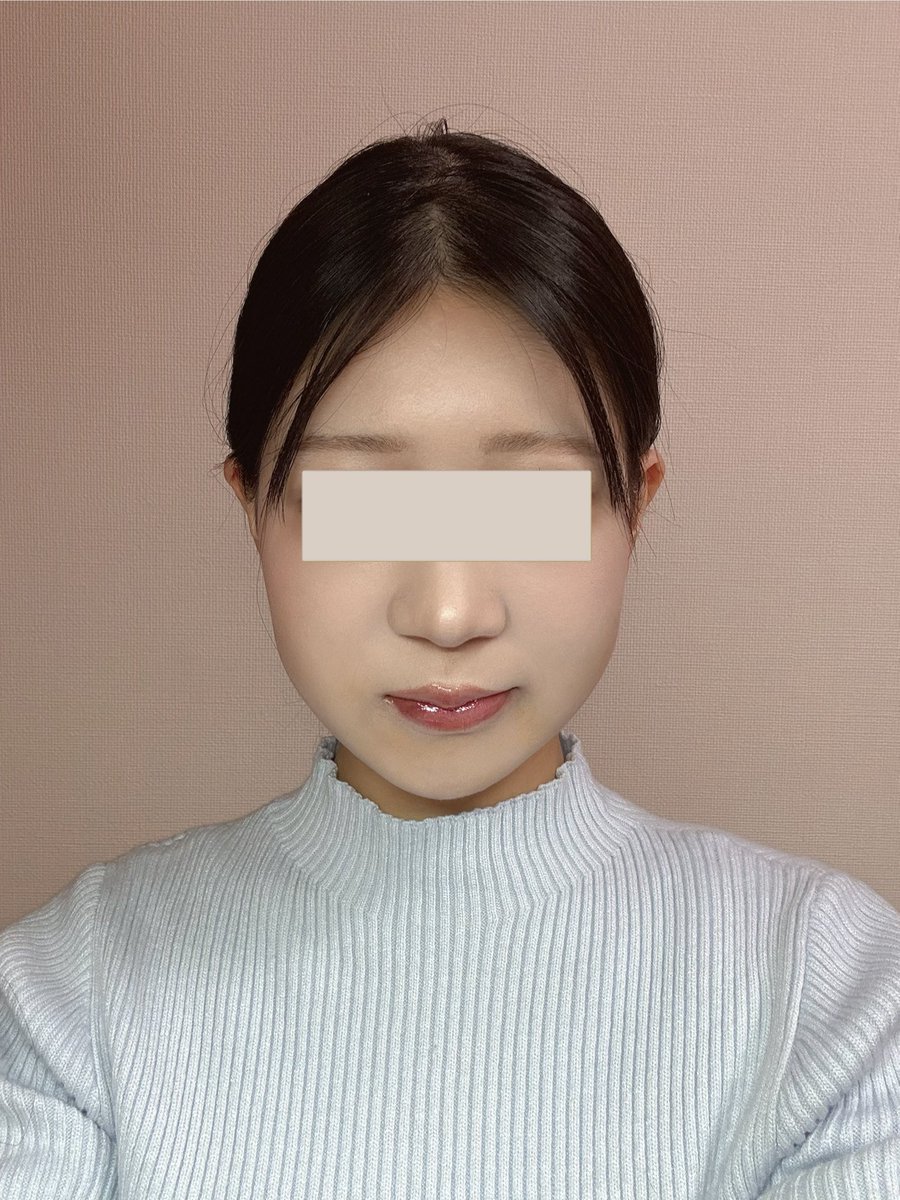 QZi164's tweet photo. #ベリーグッド美容整形外科 で、ミニVラインと顎先縮小（U字）の輪郭手術をしました。
執刀医はパク先生です✨️
こちら術後1ヶ月の写真となります

ソウル特別市 瑞草区 瑞草大路77キル 17 , 9F
江南駅10番出口より徒歩5分

日本語通訳あり✨️ https://t.co/8P2hmBIdSh