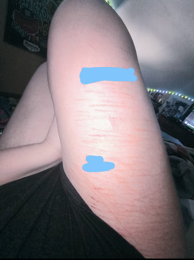 prettypuppy14's tweet image. I hate to look at my legs like this cause why's this one so cut up and the other isnt 
#shtwt
#shedtwt
#cuts