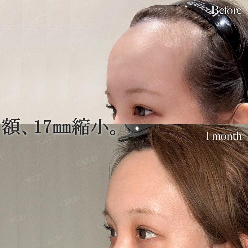 オンユ美容整形外科・美容皮膚科 【額縮小/挙上/リフトアップ】専門🎖 tweet media