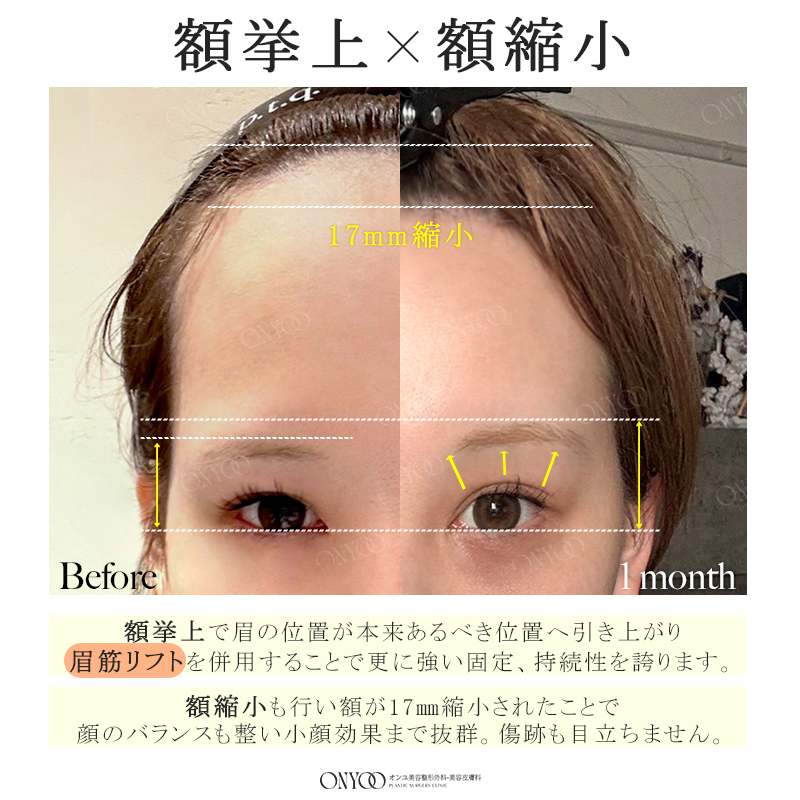 オンユ美容整形外科・美容皮膚科 【額縮小/挙上/リフトアップ】専門🎖 tweet media