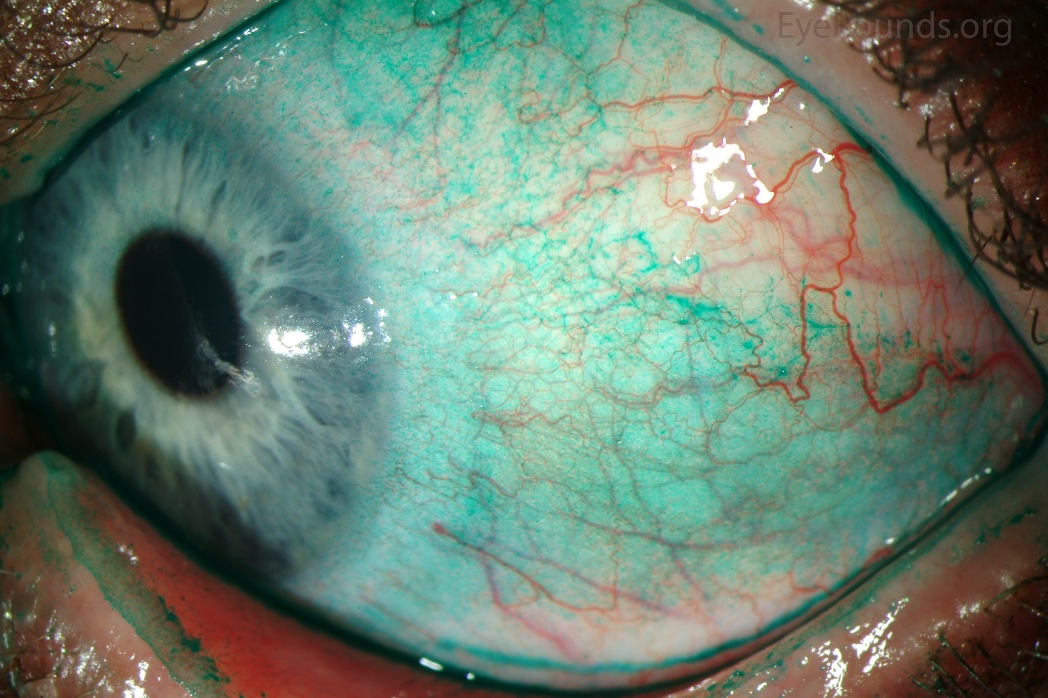 drgunjand's tweet image. Lissamine green stain.

#MedTwitter #ophthalmology #neetpg 
Image @EyeRounds