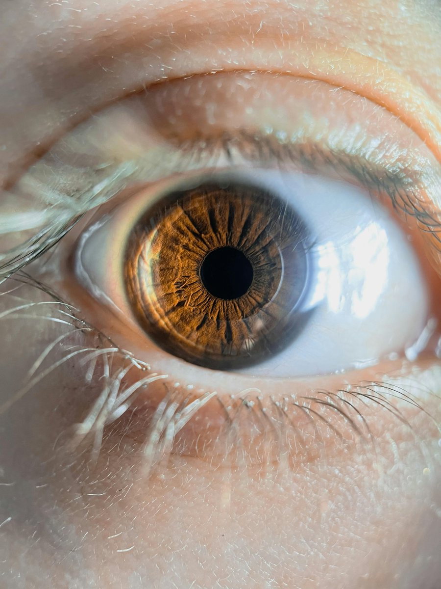 GenflowBioIR's tweet photo. 🧬 @GenflowBioIR is investigating the potential of #SIRT6-driven gene therapy in glaucoma, a leading cause of irreversible #blindness.

By addressing underlying #aging processes and #DNA repair mechanisms, the goal is to shift beyond  management toward vision preservation. https://t.co/Q1eDUjfE61