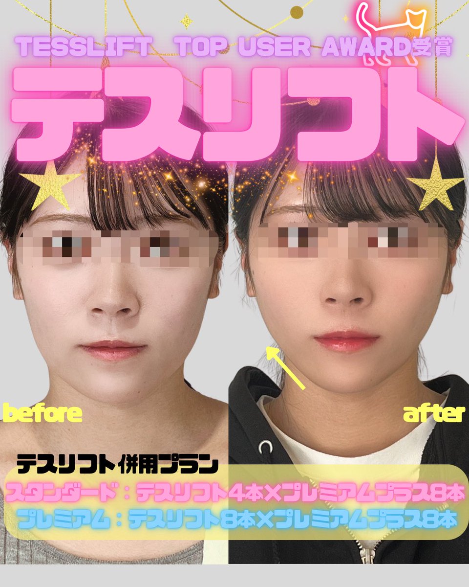 BONBONCLINIC's tweet photo. 予約殺到‼️大人気医師🧑🏻‍⚕️🌟
【池田先生症例】です🪄
この度、ボンボンクリニックが【テスリフトトップユーザーアワード2025】に選ばれました🏆🥳🎊

症例件数が豊富な医師による施術を是非受けてください⤴️🧚🏻‍♀️✨

ヒアル・ボトックス・カベリンも
お得なクーポン🎁LINE限定で配布中🌈

📲今すぐチェックしてねっ💌

☎️03-6263-8261
LINE▶️【@bonbonclinic】で検索🔍

#銀座美容 #bonbonclinic #糸リフト #ヒアルロン酸 #ボトックス