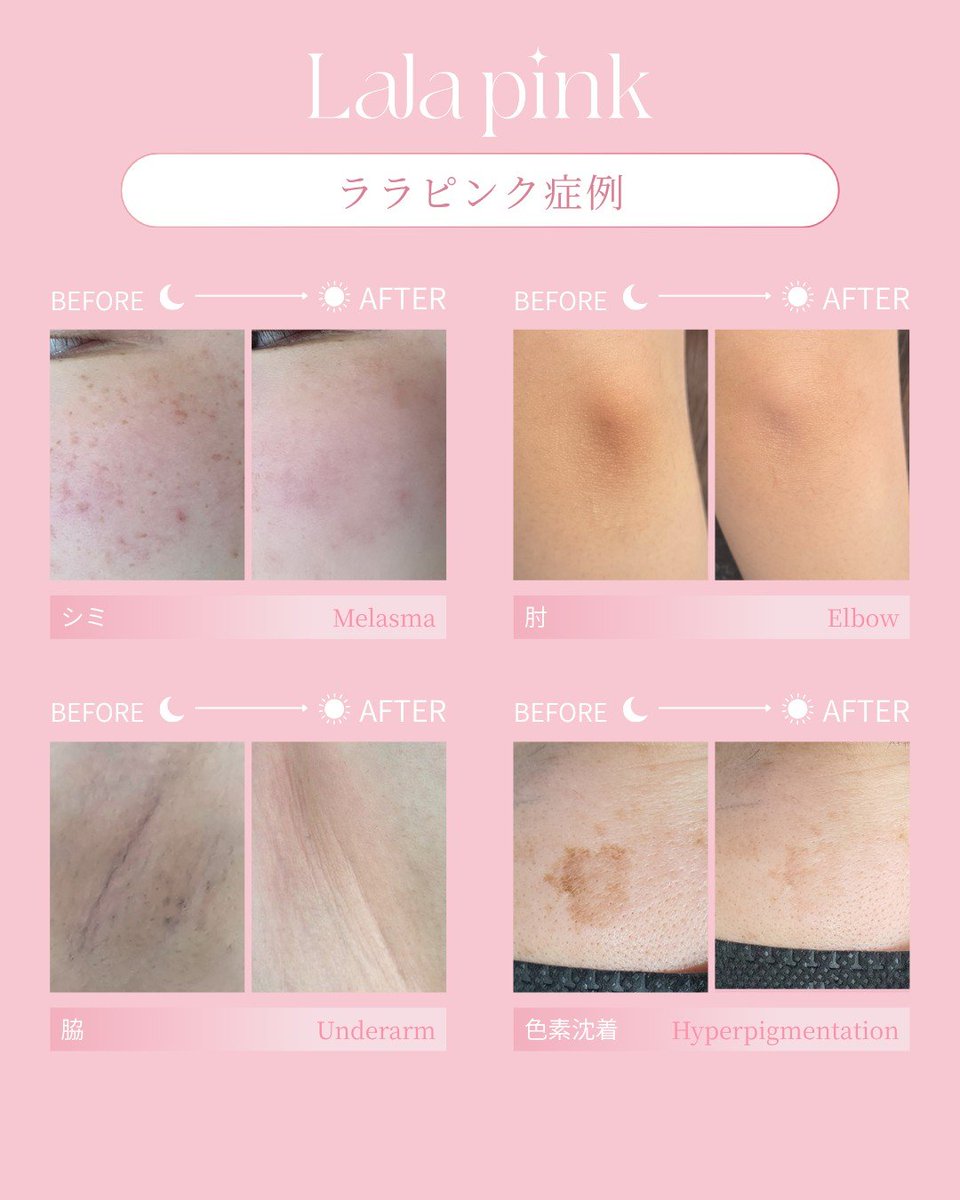 シミや色素沈着、
そのままにしてない？

ララピンクは
気になる色ムラにアプローチして
肌トーンを均一に整えるケア。

シミ・くすみ・黒ずみなど
幅広い色素悩みに対応✨

透明感のある肌印象へ。

#リンリン
#肌管理サロンリンリン
#ララピンク
